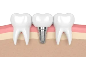 How Dental Implants Can Improve Your Quality of Life