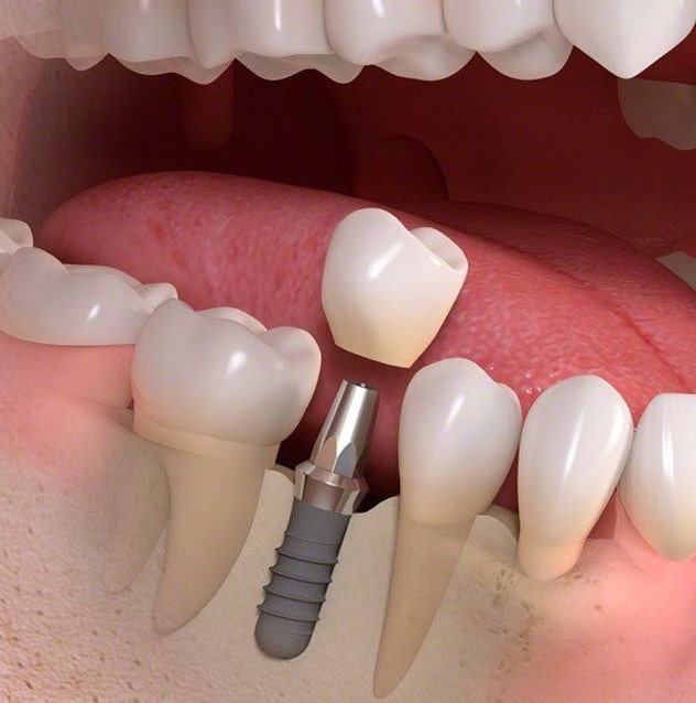 img-What are Single Tooth Implants & Bridges (2) img-What are Single Tooth Implants & Bridges (2)