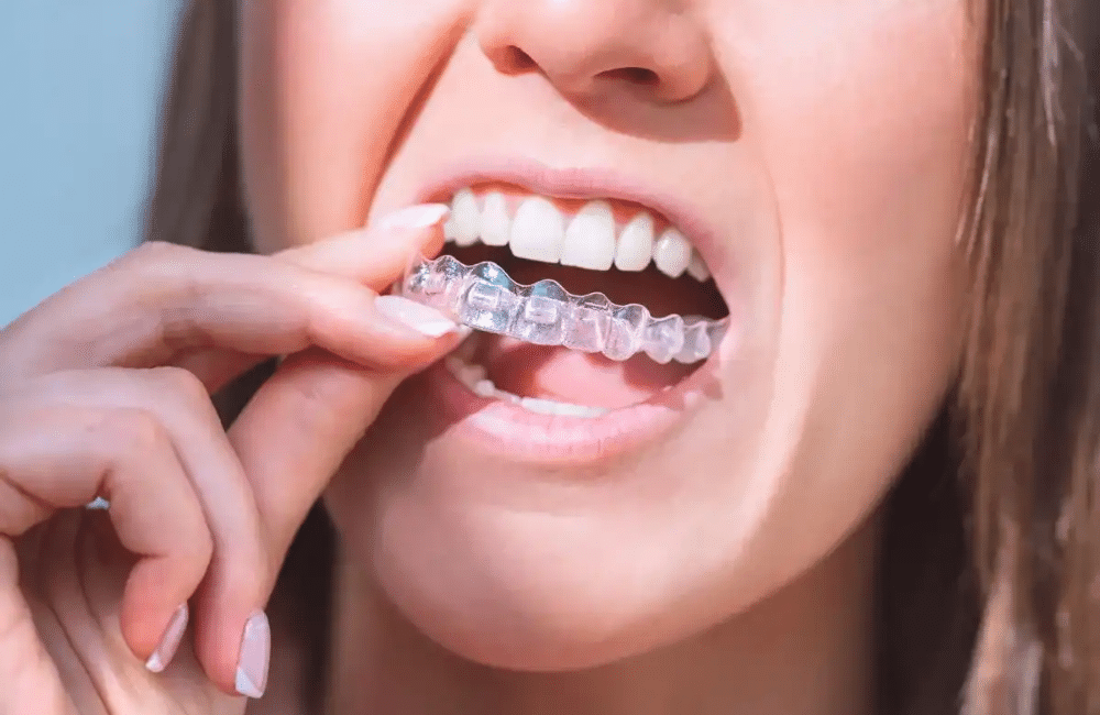 How Much Does Invisalign Cost - Invisalign Dentist Magnolia - Floss Dental Of Magnolia, Tx