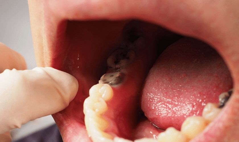 How To Handle Dental Cavities Guide From Best Dentist