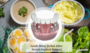 What To Eat After Dental Implant Surgery