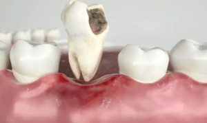 Is Tooth Extraction A Better Option For A Large Decay On A Tooth