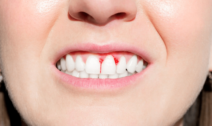 What Does It Mean If Your Gums Randomly Bleeding