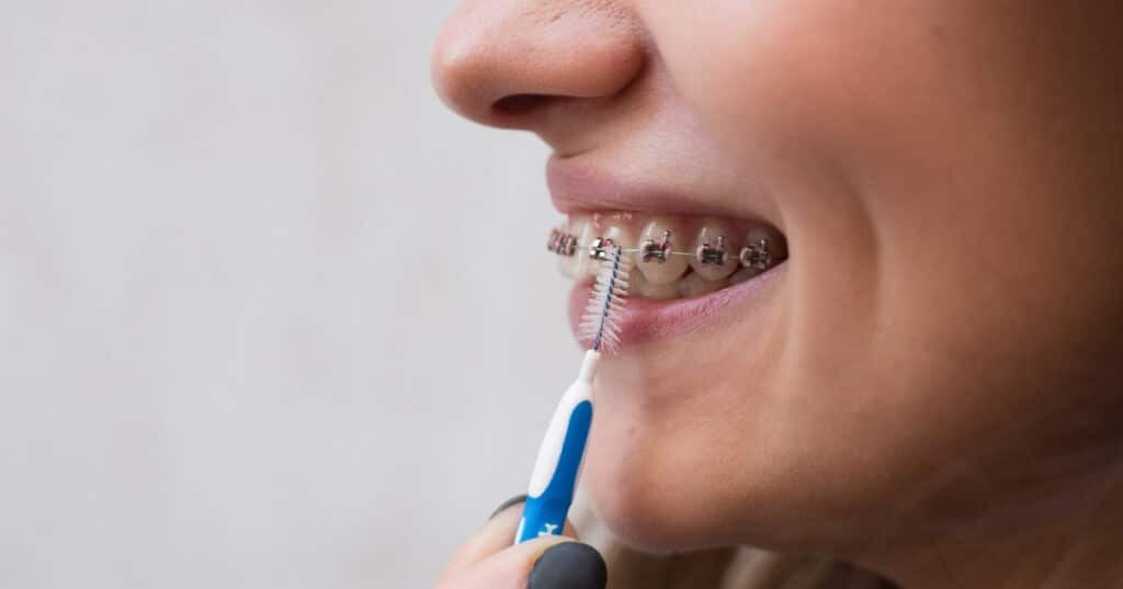 whitening teeth with braces