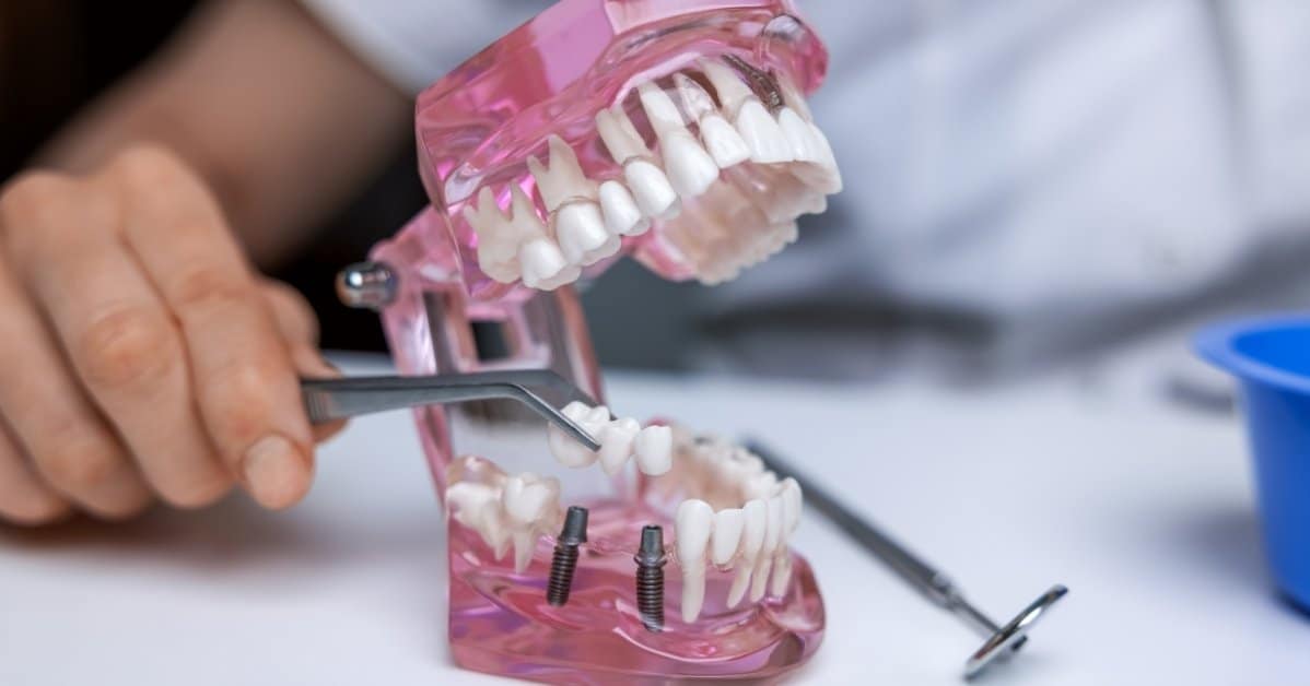 signs of successful healing after full mouth implant surgery